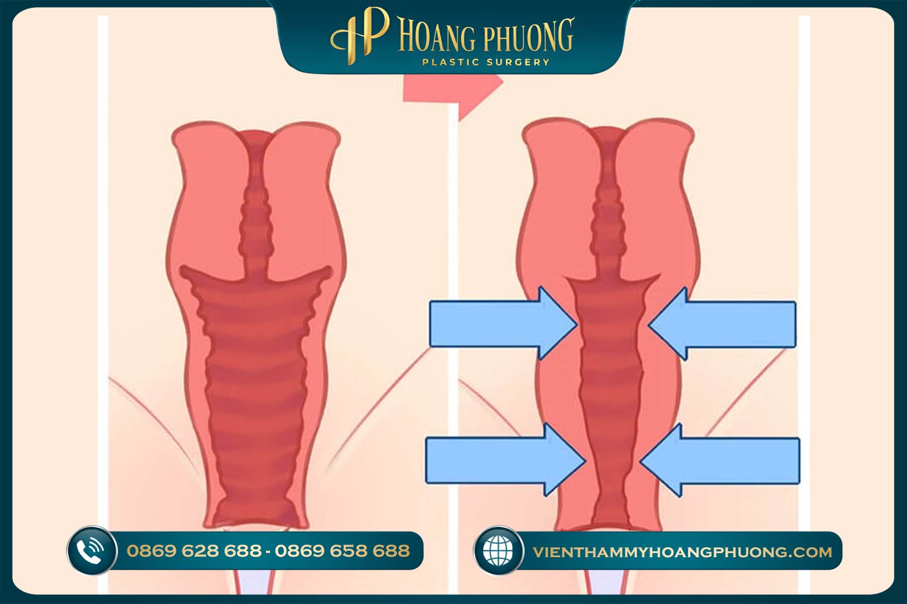 Thu nhỏ âm đạo là gì?