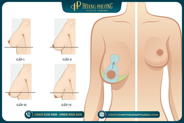 Nâng ngực bị chảy xệ bằng phương pháp treo sa trễ