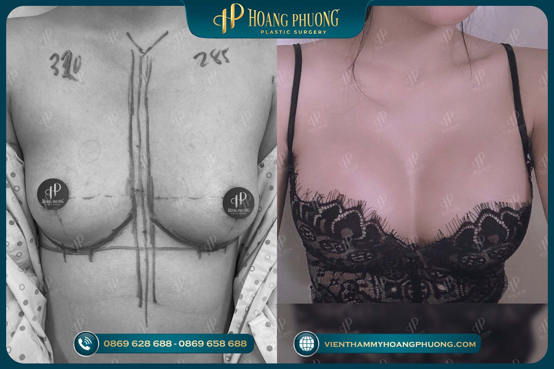 Trước và sau 1 tháng nâng ngực Y-Shape tại Thẩm Mỹ Hoàng Phương