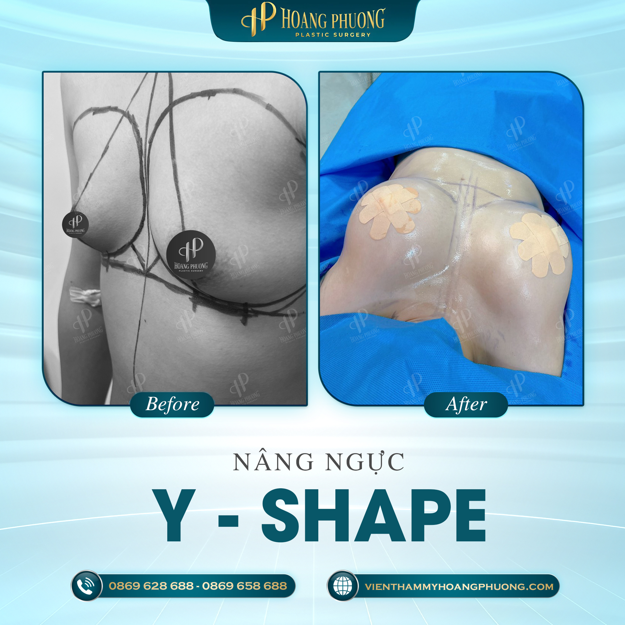 Trước và sau phẫu thuật nâng cấp vòng 1